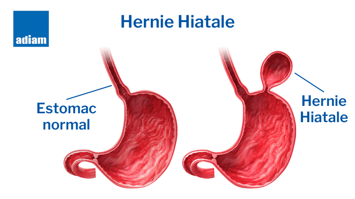 Hernie hiatale : symptome, traitement, Exercices | RGO Trouble ...